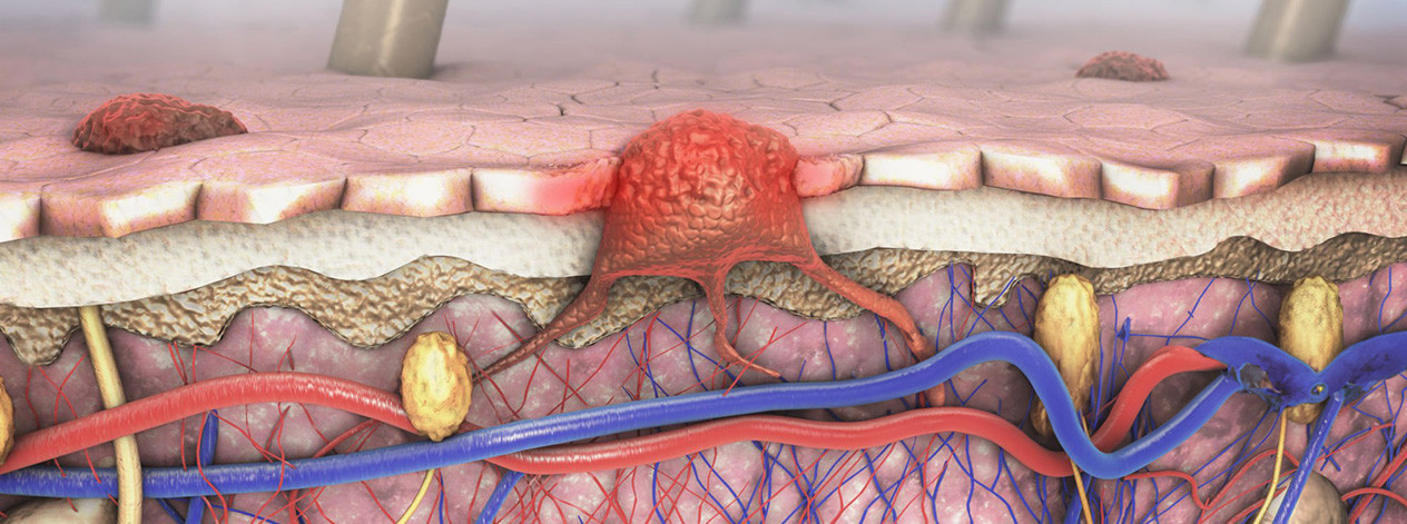 melanoma-3d-illustration-cancer-type